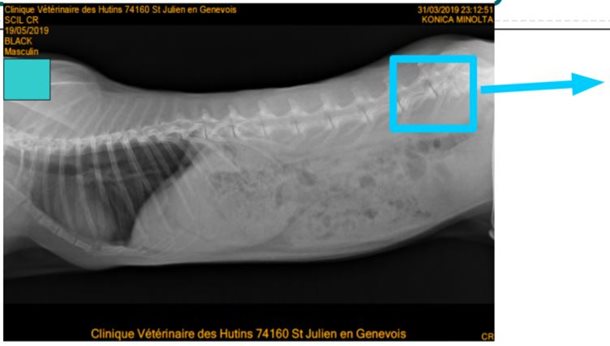 Radio de la colonne montre une fracture vertébrale en L6 avec luxation L6-L7