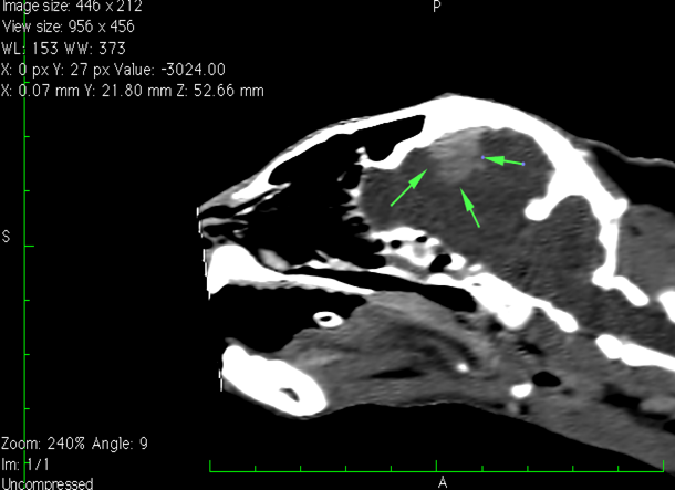 Images compatibles avec un processus tumoral de type méningiome (lymphome, sarcome histiocytaire non exclu). Un processus granulomateux semble beaucoup moins probable. 2