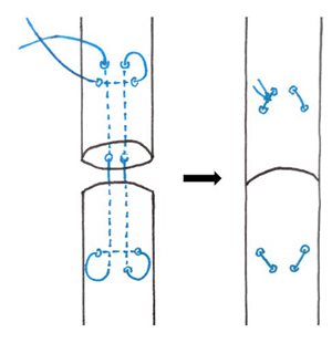 Figure 4 : Schématisation de la réalisation d’un triple nœud de poulie d’un nœud auto-bloquant (à droite en bleu).