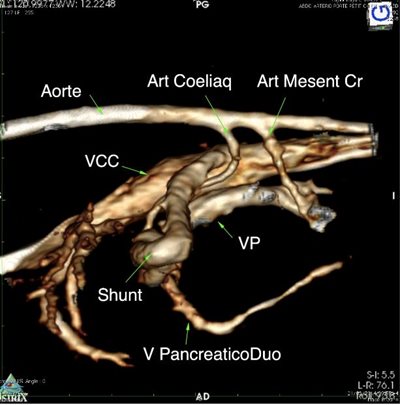 Examen tomodensitométrique : Angioscanner abdominal