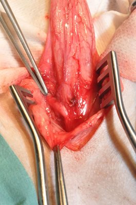 Identification de l’abouchement extramural 1-2 cm caudalement au col vésical  Dissection, Ligature et section de l’uretère