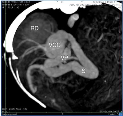 Examen tomodensitométrique : Angioscanner abdominal